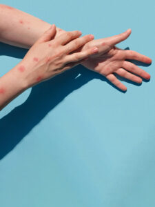 Monkeypox
