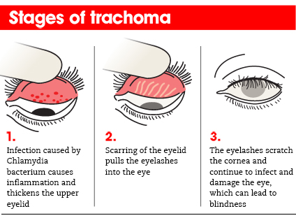 Trachoma Disease Eliminated by India: WHO_4.1