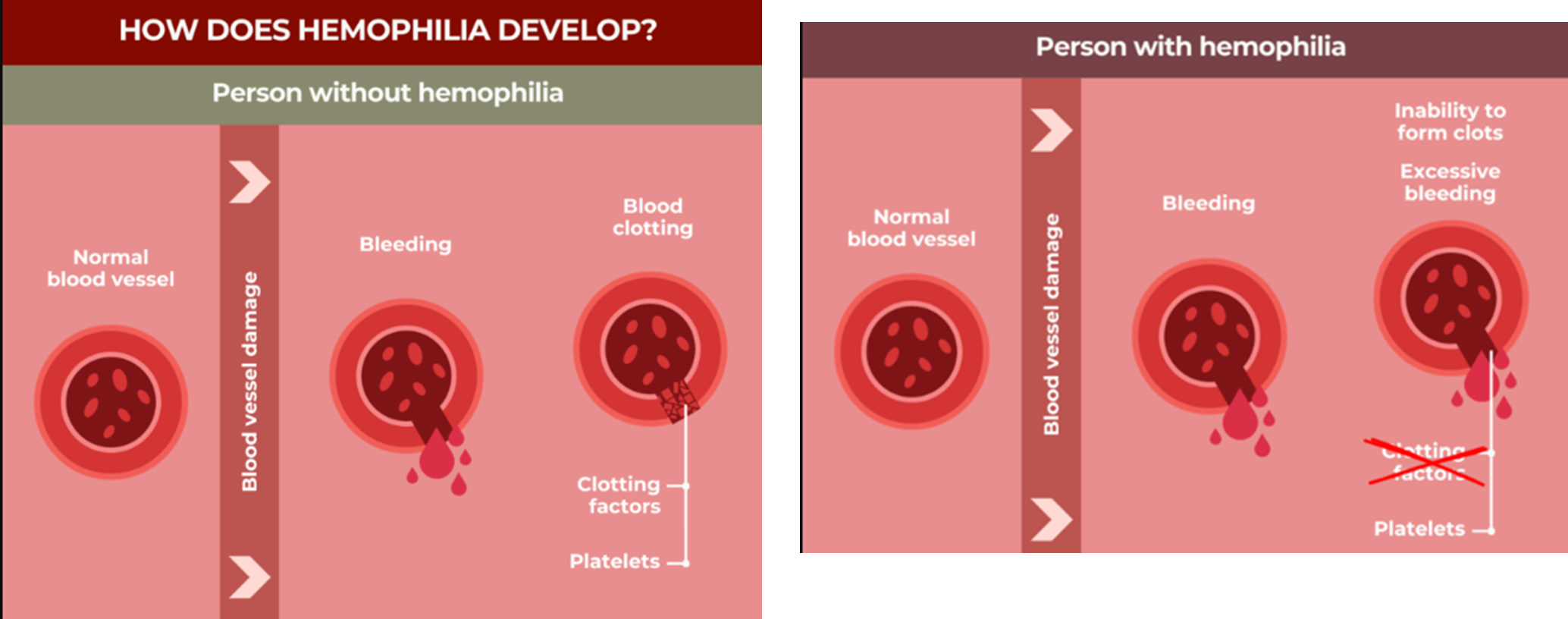 Gene therapy for Haemopholia_3.1