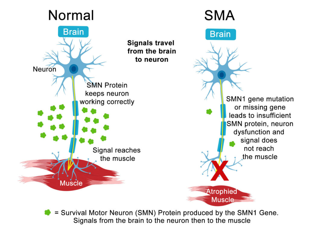 Spinal Muscular Atrophy (SMA)