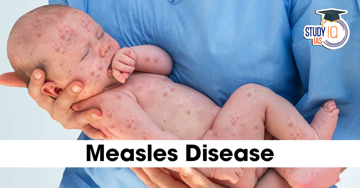 Measles Disease