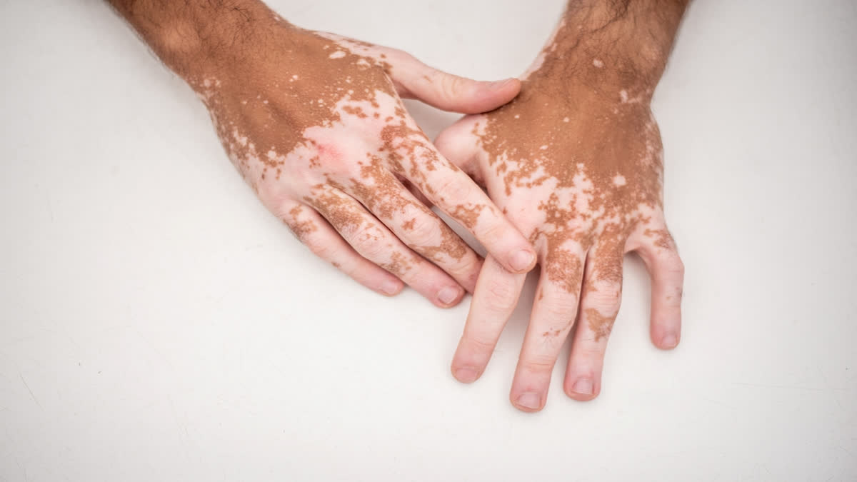 What is Vitiligo