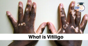 What is Vitiligo