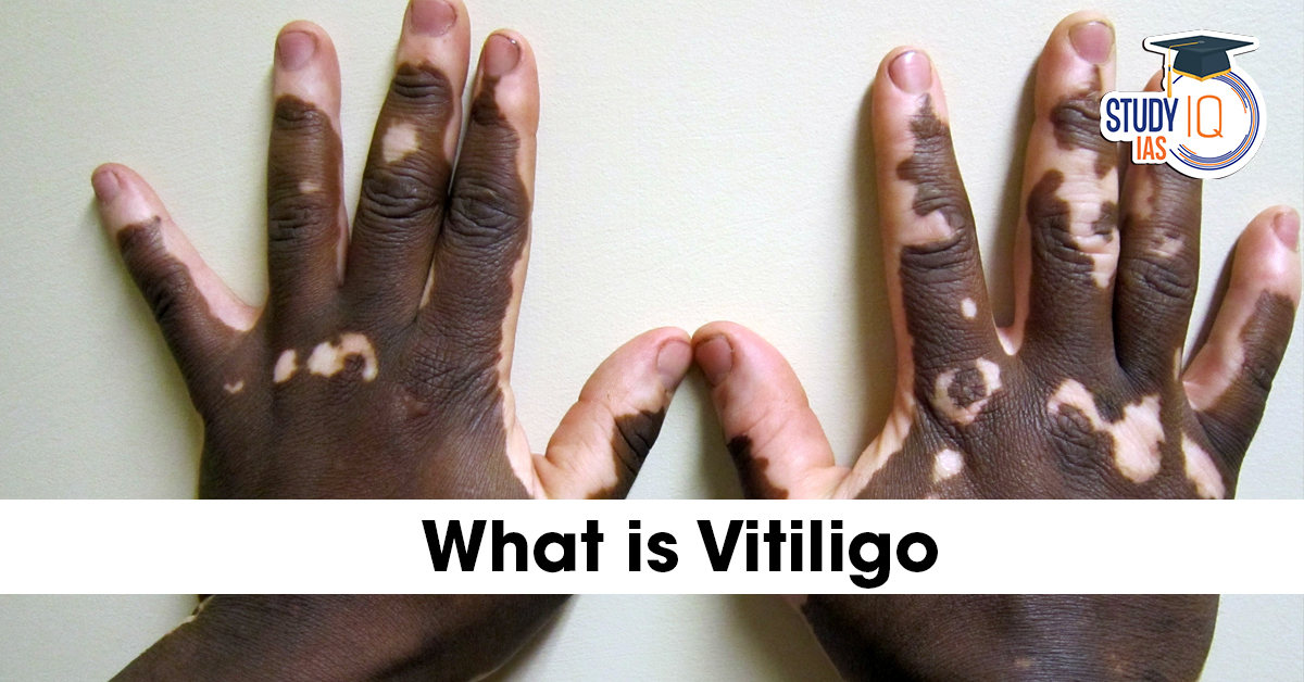 What is Vitiligo