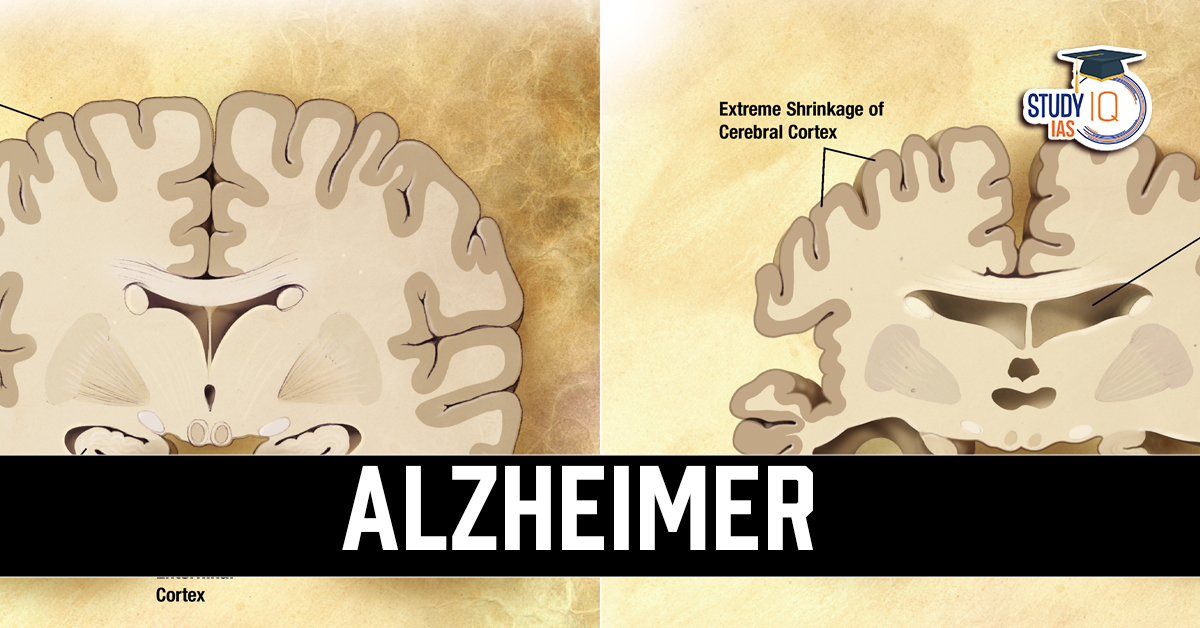 Alzheimer disease