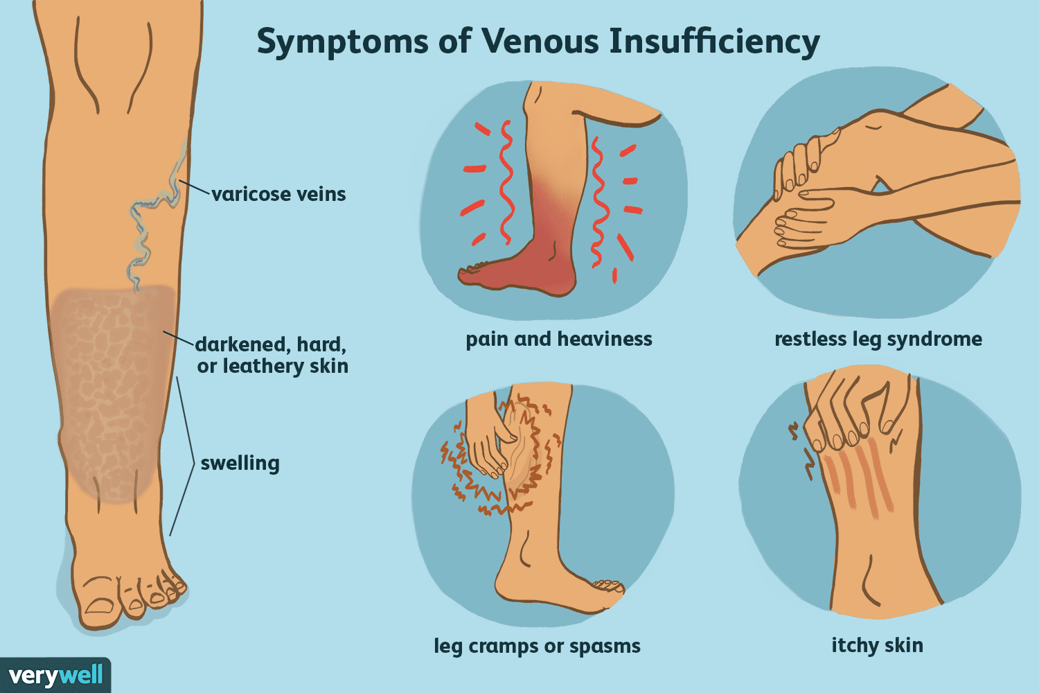 Chronic Venous Insufficiency