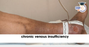 Chronic Venous Insufficiency (CVI): Symptoms, Risks and Treatment