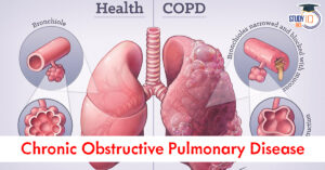 Chronic Obstructive Pulmonary Disease